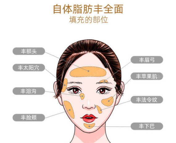自体脂肪胶