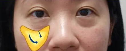 自体脂肪胶