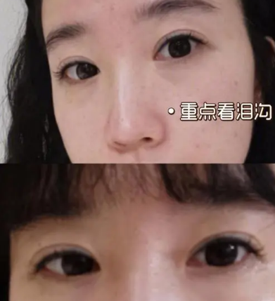 泪沟填充