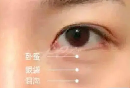 泪沟填充