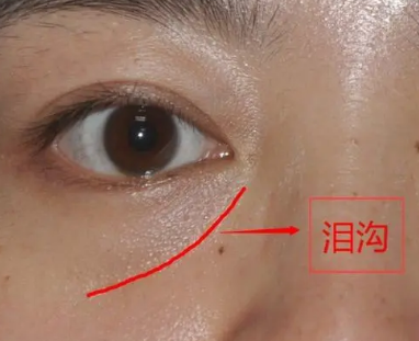 泪沟填充