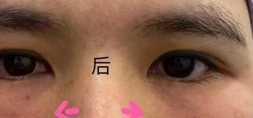 泪沟填充