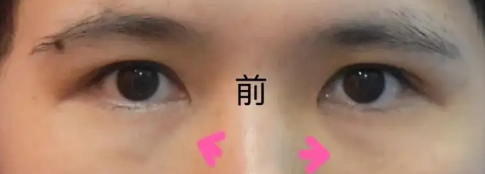 泪沟填充