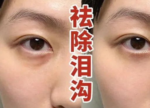 泪沟填充