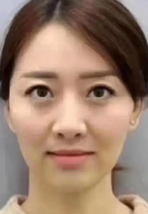 泪沟填充