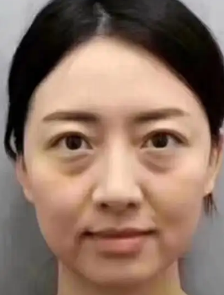 泪沟填充