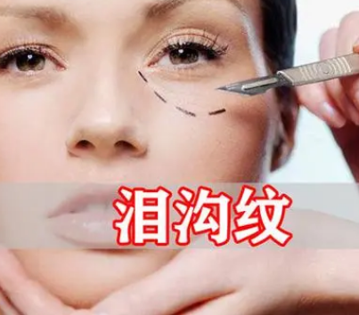 泪沟