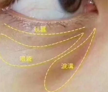 泪沟填充