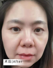 去眼袋手术