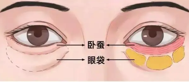 去眼袋手术