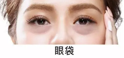 去眼袋手术
