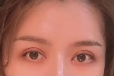 双眼皮手术