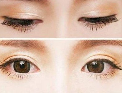 双眼皮手术