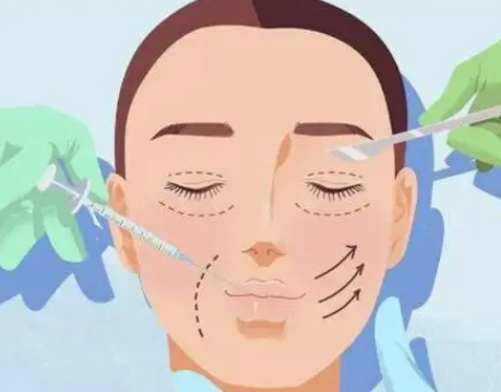 双眼皮手术