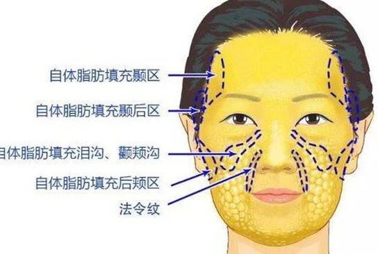 自体脂肪胶
