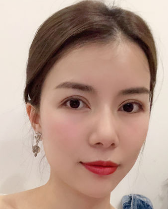 自体脂肪胶
