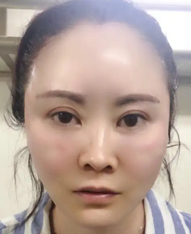 自体脂肪胶