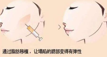 自体脂肪胶