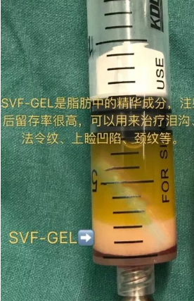 自体脂肪胶