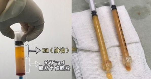 自体脂肪胶