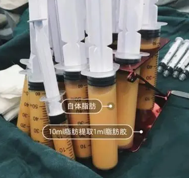 自体脂肪胶