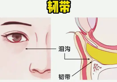 泪沟填充