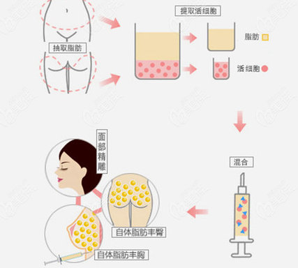 自体脂肪胶