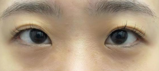 去眼袋手术