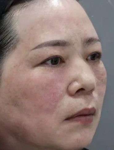 去眼袋手术