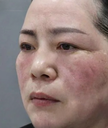 去眼袋手术