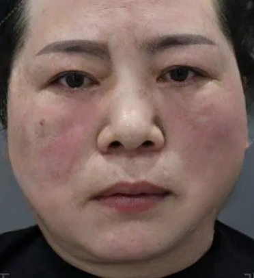 去眼袋手术
