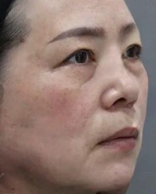 去眼袋手术
