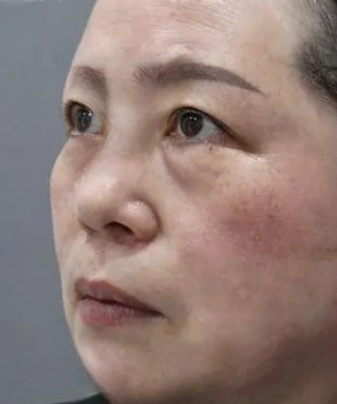 去眼袋手术