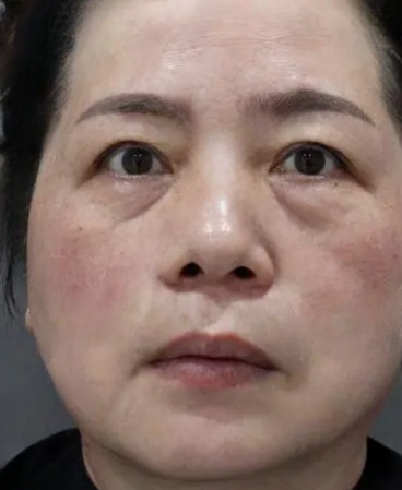 去眼袋手术