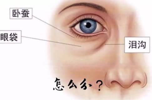去眼袋手术