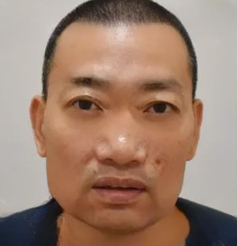 去眼袋手术