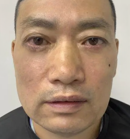 去眼袋手术
