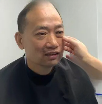 去眼袋手术