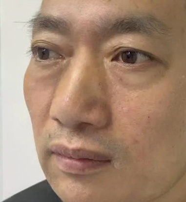 去眼袋手术