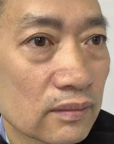 去眼袋手术