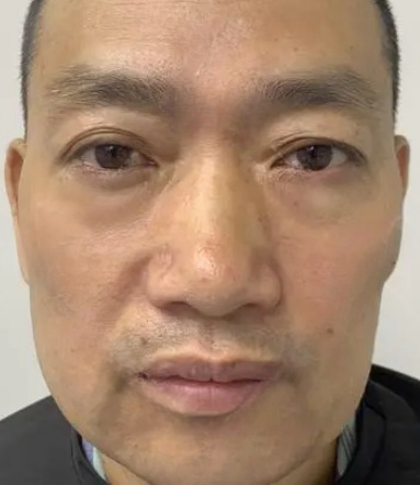 去眼袋手术