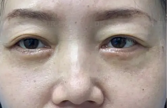去眼袋手术