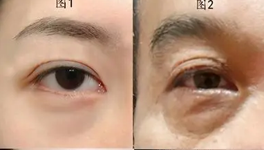 去眼袋手术