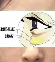 去眼袋手术