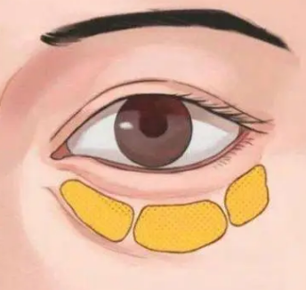 去眼袋手术