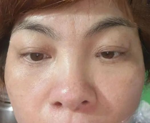 去眼袋手术