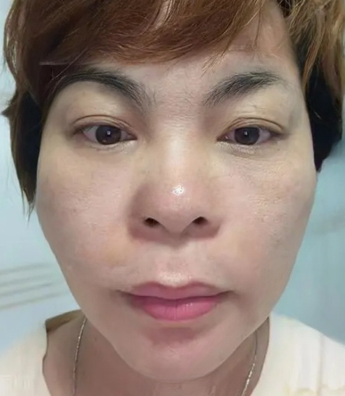 去眼袋手术
