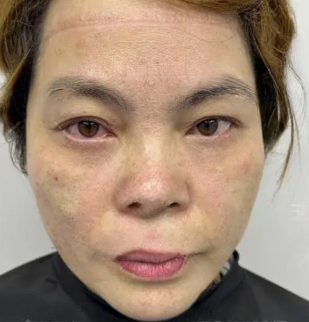 去眼袋手术