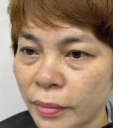 去眼袋手术