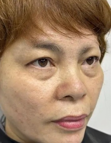 去眼袋手术